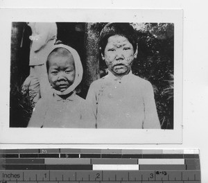 Two children with leprosy at Jiangmen, China, 1935