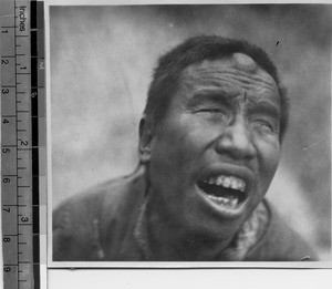 Beggar with lump on head, Yachow, Sichuan, China ca.1915-1925