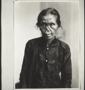 Dajak woman whose deformed face was caused by yaws (healed by the missionary's use of iodine)
