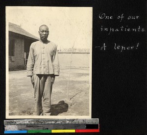 A Chinese patient with leprosy, Xianfu, Shaanxi, China, ca. 1885