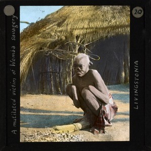 "A mutilated victim of Wemba savagery, Livingstonia", ca.1910