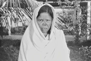 Danish Bangladesh Leprosy Mission/DBLM. A leper woman at Nilphamari Hospital, 1980