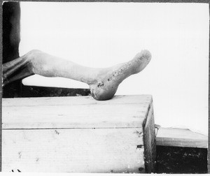 African with jigger flea-bitten feet, leg seen from the side, Mamba?, Tanzania, ca.1901-1910