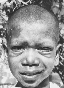 Leprosy patient: Mari 10 years old - from Vadathosalalur, Arcot, South India, 1971