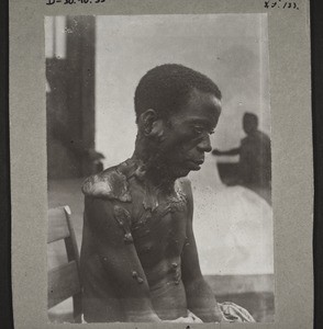 African man with scars