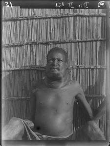 African patient, Matutwini, Mozambique, ca. 1930