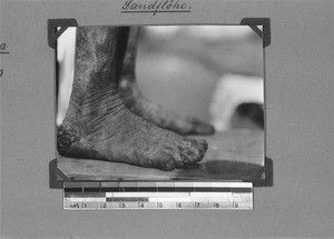 Feet of an African suffering from jiggers, Nyasa, Tanzania, 1929