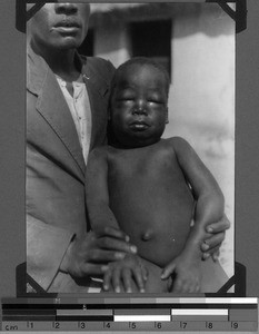 A child suffering from nephritis, Sikonge, Unyamwezi, Tanzania