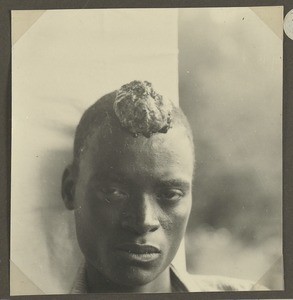 Man infected by buruli ulcer, Tanzania, ca.1929-1940