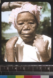 Female leper patient, Mandalay, Myanmar, s.d