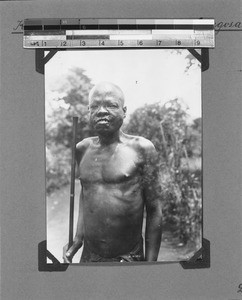 African man suffering from yaws, Nyasa, Tanzania, 1929