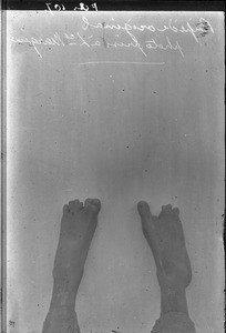 Feet of a patient, Maputo, Mozambique, ca. 1914-1930