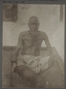 Man suffering from elephantiasis, India