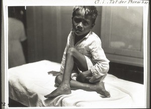 Boy with TB in his ankles (in the process of healing)