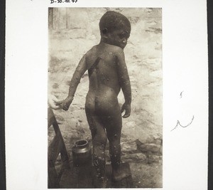 Child with leprosy