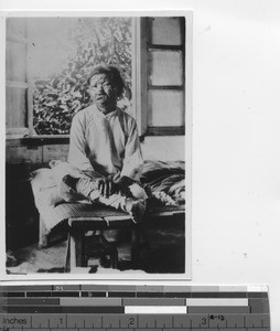 A person with advanced leprosy at Jiangmen, China