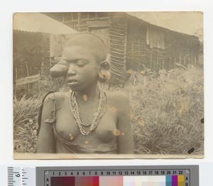 Young girl with eye tumour, Kikuyu, Kenya, ca.1904