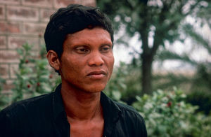 Diasserie, Bangladesh 1990: "Spedalskhed - den gamle svøbe" - Nr. 10: En spedalsk mand. Spedalskhed er en sygdom, der kan komme til udtryk på mange måder, og ved undersøgelse er det vigtigt at holde øje med mange forskellige symptomer, der kan tyde på sygdommen. Denne mand har ingen lyse pletter på huden, men øjenbryn og vipper er forsvundet. Det er også et tegn på spedalskhed