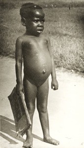 Small girl with swollen belly, Nigeria, ca. 1938