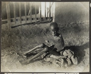 Child suffering from hookworms, Tanzania, ca.1933-1935