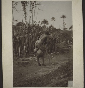 A woman suffering from Elephantiasis