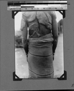 Clinical picture of keloids at the back and arms, Nyasa, Tanzania, 1929