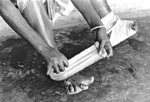 Danish Bangladesh Leprosy Mission/DBLM. A leper patient trying to protect her feet with a banda