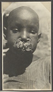 Sarcoma of the upper lip, Tanzania, ca.1932-1940