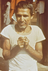 DBLM, Nilphamari, January 1975. A leper patient with claw hands and callous fingers