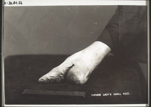 Crippled foot of a chinese lady from Shanghai