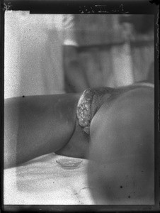 Vulva and vagina cancer, Matutwini, Mozambique, ca. 1930