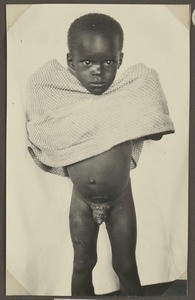 Yaws, Tanzania, ca.1929-1940