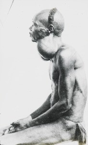 Man with swollen glands, Congo, ca. 1900-1915