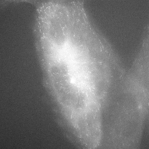 CIL:31264, Homo sapiens, epithelial cell, renal cell carcinoma