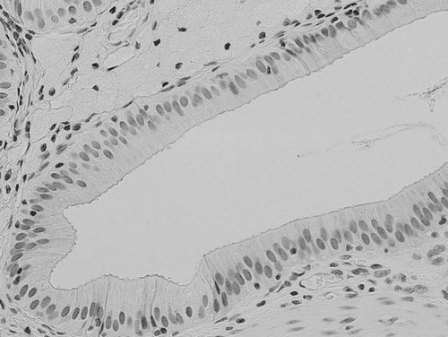 CIL:34864, Homo sapiens, epithelial cell, foam cell