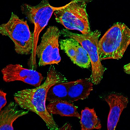 CIL:40461, Homo sapiens, osteosarcoma