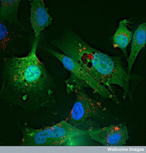 CIL:38961, glioblastoma