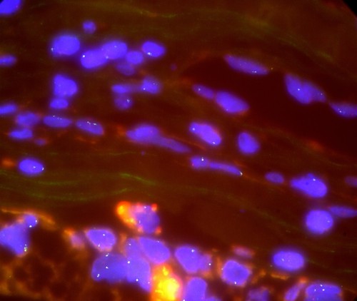 CIL: 53011, Homo sapiens, High-grade serious overian cancer