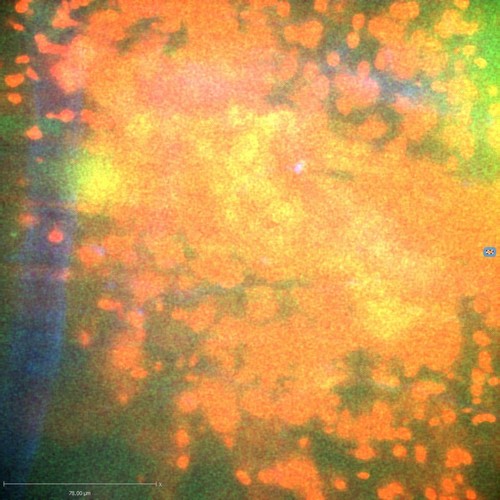 CIL:47313, Staphylococcus aureus, neutrophil, endothelial cell