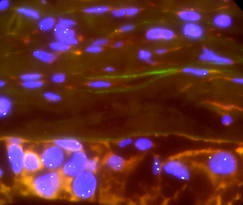 CIL: 53052, Homo sapiens, High-grade serious overian cancer