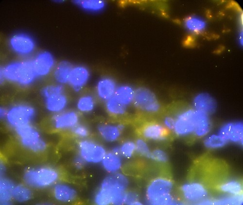 CIL: 53111, Homo sapiens, High-grade serious overian cancer — Calisphere