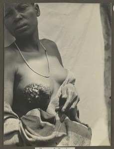 Yaws, Tanzania, ca.1929-1940