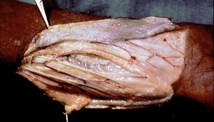 Natural color photograph of dissection of the forearm