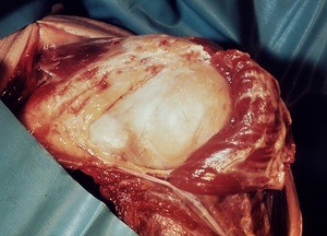 Natural color photograph of dissection of the left shoulder, anterior view, with the deltoid muscle reflected to expose the glenohumeral joint capsule