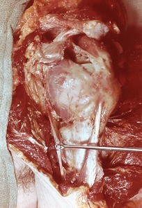 Natural color photograph of dissection of the left shoulder, lateral view, with the deltoid muscle removed to head of the humerus and its associated tendons