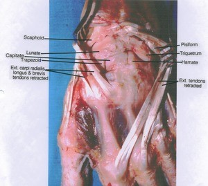 Natural color photograph of dissection of left wrist, posterior view, showing bones with the extensor tendons retracted