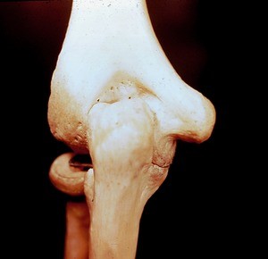Color photograph of articulated dried bones of left elbow, posterior aspect; seen: are medial and lateral humeral epicondyles, radial head, olecranon process of ulna, olecranon fossa of humerus