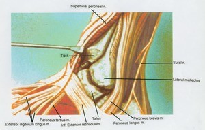 Illustration of dissection of the left ankle joint, lateral view, showing the tibia, the talus and the lateral maleolus, with the overlying musculature retracted