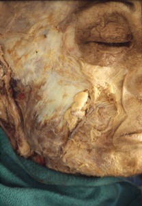 Natural color photograph of superficial dissection of the face, right lateral view