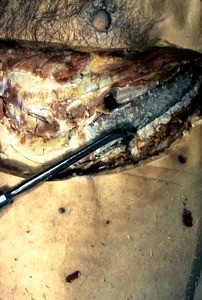 Natural color photograph of dissection of the right thorax, anterior view, with skin and superficial muscle removed in one area to expose the 5th rib while leaving some surface anatomy